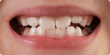 Лечение молочных и постоянных зубов