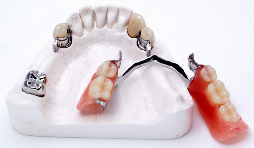 бюгельный зубной протез