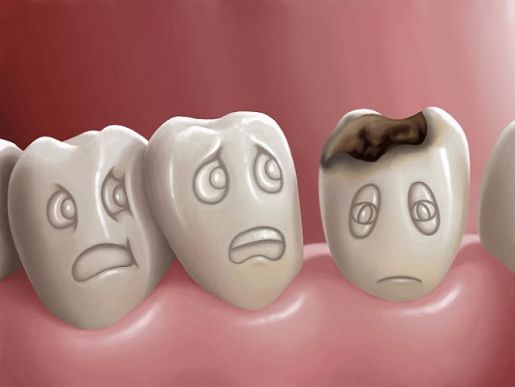 Лечение кариеса молочных зубов