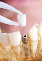 Сложная имплантация зубов