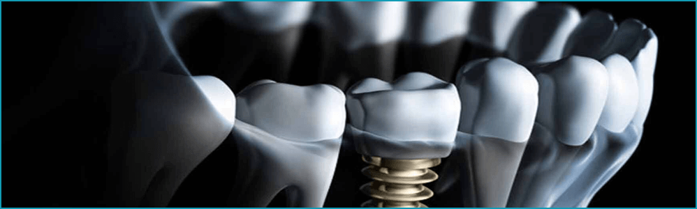 Сколько стоит поставить имплант зуба