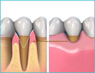 клиновидный дефект зубов
